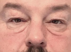 Ögonlocksplastik före och efter – övre och nedre ögonlock (före)
