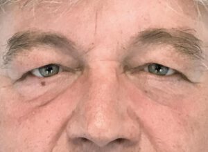 Ögonlocksplastik före och efter – övre och nedre ögonlock (före)