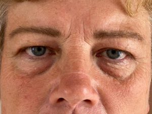 Ögonlocksplastik före och efter – övre och nedre ögonlock (före)