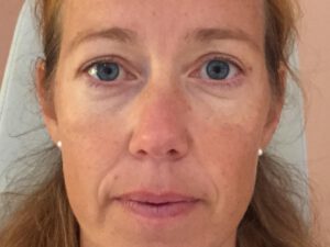 Ögonlocksplastik före och efter – övre och nedre ögonlock (efter)