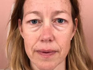 Ögonlocksplastik före och efter – övre och nedre ögonlock (före)