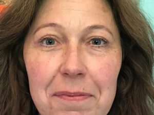 Ögonlocksplastik före och efter – övre och nedre ögonlock (efter)
