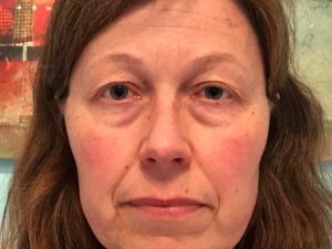 Ögonlocksplastik före och efter – övre och nedre ögonlock (före)