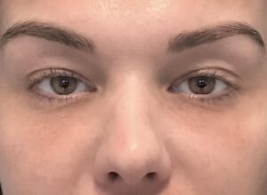 Ögonlocksplastik före och efter – övre ögonlock (före)