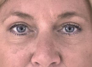 Ögonlocksplastik före och efter – övre ögonlock (efter)