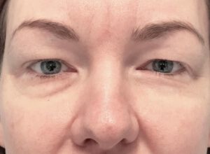 Ögonlocksplastik före och efter – övre ögonlock (före)