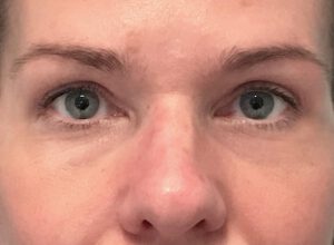Ögonlocksplastik före och efter – övre ögonlock (efter)
