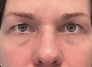 Ögonlocksplastik före och efter – övre ögonlock (före)