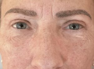 Ögonlocksplastik före och efter – övre ögonlock (efter)