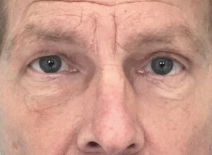 Ögonlocksplastik före och efter – övre ögonlock (efter)