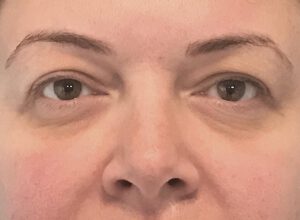 Ögonlocksplastik före och efter – övre ögonlock (före)