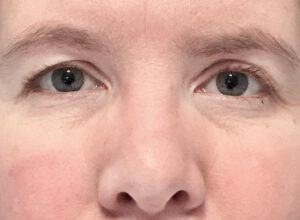 Ögonlocksplastik före och efter – övre ögonlock (före)