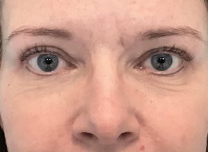 Ögonlocksplastik före och efter – övre ögonlock (efter)