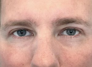 Ögonlocksplastik före och efter – övre ögonlock (efter)