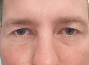 Ögonlocksplastik före och efter – övre ögonlock (före)