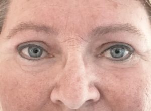 Ögonlocksplastik före och efter – övre ögonlock (efter)