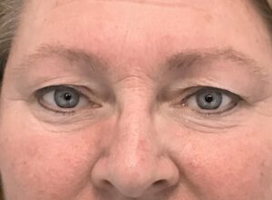 Ögonlocksplastik före och efter – övre ögonlock (före)
