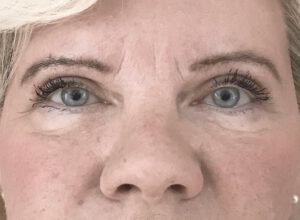 Ögonlocksplastik före och efter – övre ögonlock (efter)