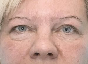 Ögonlocksplastik före och efter – övre ögonlock (före)