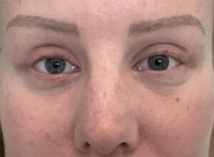 Ögonlocksplastik före och efter – övre ögonlock (efter)
