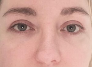 Ögonlocksplastik före och efter – övre ögonlock (efter)