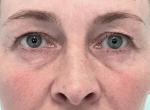 Ögonlocksplastik före och efter – övre ögonlock (före)