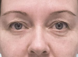 Ögonlocksplastik före och efter – övre ögonlock (före)
