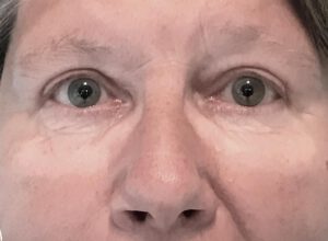 Ögonlocksplastik före och efter – övre ögonlock (efter)