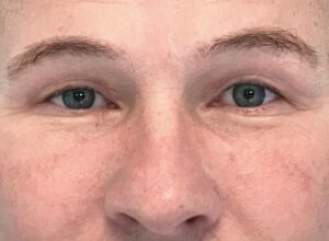 Ögonlocksplastik före och efter – övre ögonlock (efter)