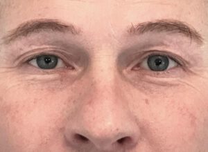 Ögonlocksplastik före och efter – övre ögonlock (före)