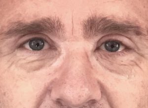 Ögonlocksplastik före och efter – övre ögonlock (efter)
