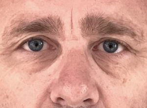 Ögonlocksplastik före och efter – övre ögonlock (före)
