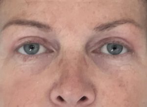 Ögonlocksplastik före och efter – övre ögonlock (efter)