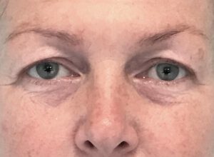 Ögonlocksplastik före och efter – övre ögonlock (före)