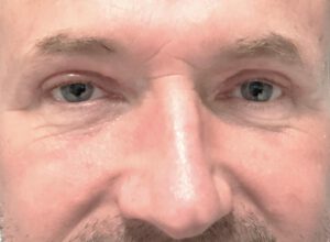 Ögonlocksplastik före och efter – övre ögonlock (efter)