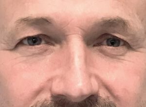 Ögonlocksplastik före och efter – övre ögonlock (före)