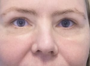 Ögonlocksplastik före och efter – övre ögonlock (efter)