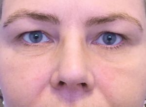 Ögonlocksplastik före och efter – övre ögonlock (före)
