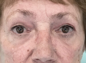 Ögonlocksplastik före och efter – övriga ingrepp (efter)