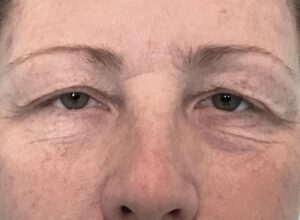 Ptosoperation före och efter – hängande ögonlockskant åtgärdad (före)