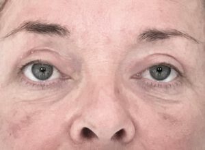 Ptosoperation före och efter – hängande ögonlockskant åtgärdad (efter)