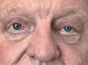 Ptosoperation före och efter – hängande ögonlockskant åtgärdad (efter)