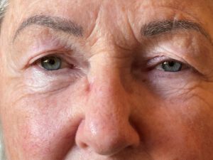 Ptosoperation före och efter – hängande ögonlockskant åtgärdad (före)