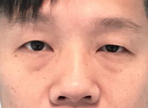 Ptosoperation före och efter – hängande ögonlockskant åtgärdad (före)