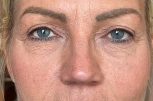 Ptosoperation före och efter – hängande ögonlockskant åtgärdad (efter)