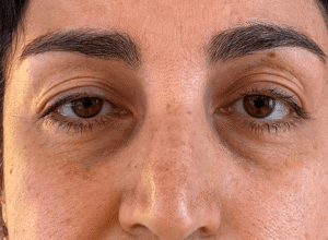 Ptosoperation före och efter – hängande ögonlockskant åtgärdad (före)
